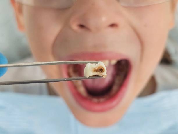 Best Emergency Dental Care for Broken or Chipped Teeth in Redwater, TX